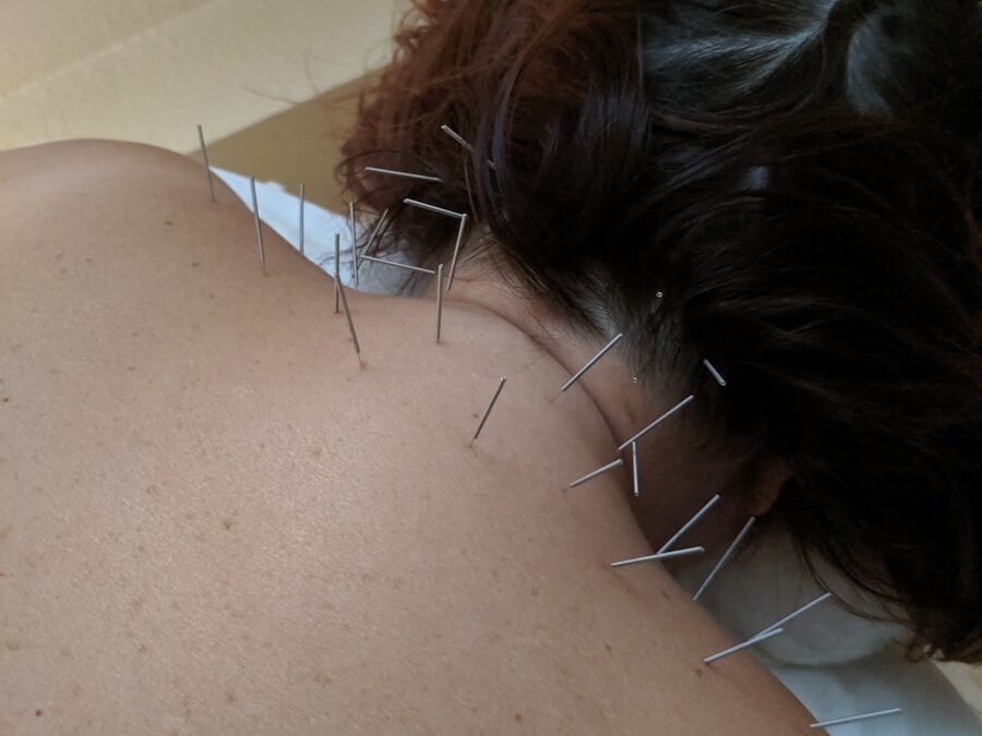 Photo "Why is acupuncture (spiritual) dangerous according to the Bible, and why ask Jesus for help instead?"